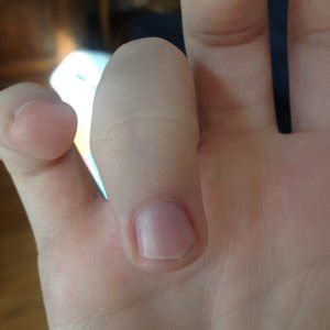 second nail growing under fingernail